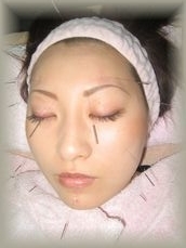 冷え性・肩こりお顔のむくみ・たるみが気になる方へ（美顔鍼＋）