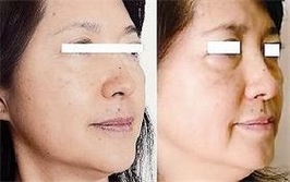 冷え性・肩こりで、お顔のむくみ・たるみが気になる方へ
（鍼を使わない ビューティーライザー+）